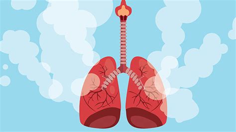 肺癌咳血特点 - 专家文章 - 复禾健康