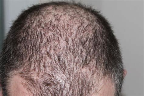 癌症化疗脱发，原来可治可防，你还不知道吗？