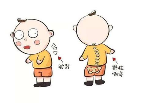 鸡胸患者图片