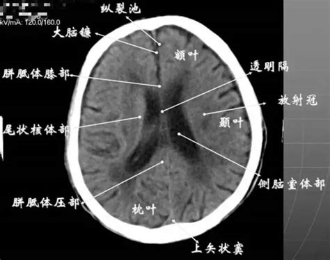 颅脑ct解剖图图片