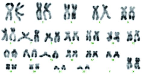 第一胎宝宝做了染色体核型分析结果为，47,XX,inv(9)(p11,q13),+18,现在 - 百度宝宝知道