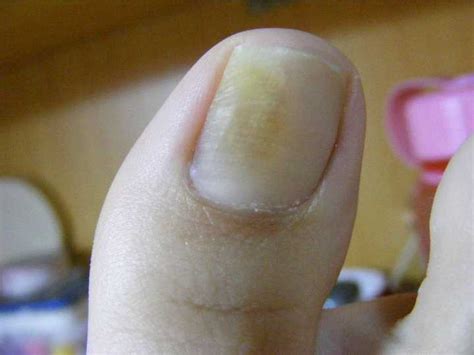 什么原因容易引发灰指甲？ 引发灰指甲疾病的六大因素是哪些？-灰指甲病因-复禾健康