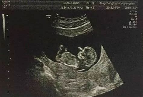 怀孕37周看B超单子怎么能看胎儿体重和性别 - 百度宝宝知道