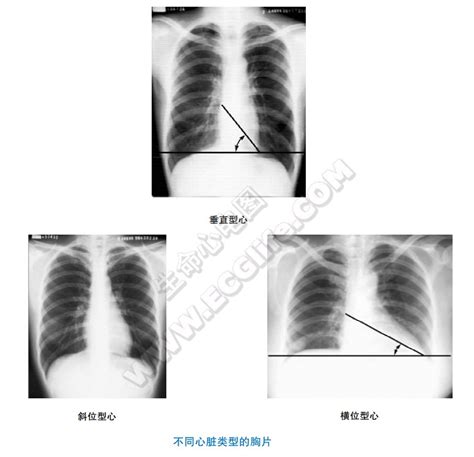 胸片心影解剖：X线摄片检查 - 心血管 - 天山医学院
