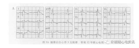 心电图对应心脏时相,收缩和舒对应心电图,心电图导联对应心壁_大山谷图库