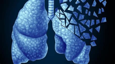 4种肺癌的基本类型，哪种肺癌最难治？-肺癌治疗-复禾健康