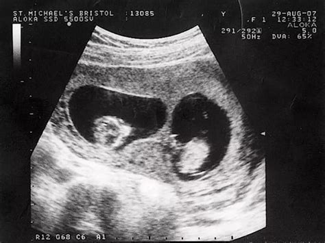 孕囊形状可以看出宝宝的性别吗 通过孕囊能看出怀了几个宝宝吗 _八宝网