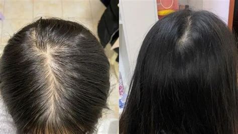脂溢性脱发（雄激素性脱发） - 适用人群 - 章光植发
