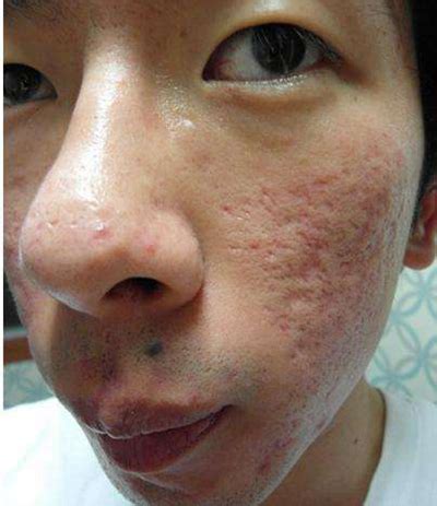 脸颊长痘的原因（脸颊长痘如何调理） | 说明书网