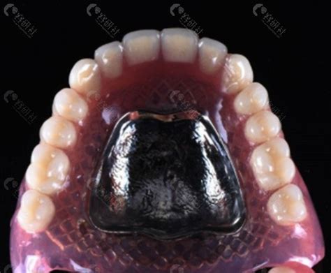 全口义齿种类及优缺点介绍,附专业牙医建议及全口义齿图片 - 爱美容研社