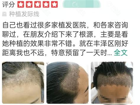 我想明年寒假去南京植发，南京有什么好的植发医院吗？最好是公立的。？ - 知乎