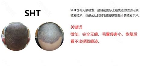 碧莲盛植发价格表公示，包含植发3000毛囊单位具体收费 - 爱美容研社