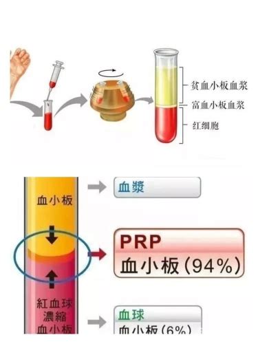 新技术，新“膝”望——文山州中医医院骨伤一科在州内率先开展自体富血小板血浆（PRP）疗法_文山壮族苗族自治州中医医院_文山壮族苗族自治州中医医院