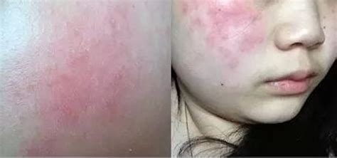 潮湿过敏症状图片
