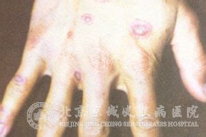 脓疱疮的初期图片