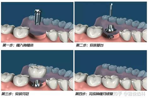 种牙图片