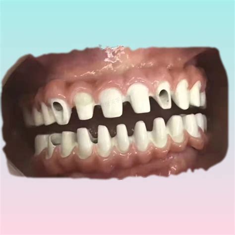 种植牙-定制式基台 - 惠州市众悦齿科技术有限公司