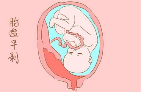 解读胎盘前壁和后壁的三大区别，哪个顺产疼一看便知|孕期知识|糖糕妈妈育儿网