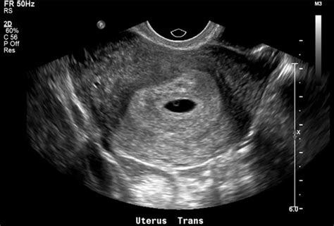 新手福利：异位妊娠的超声诊断和鉴别诊断 - 丁香园