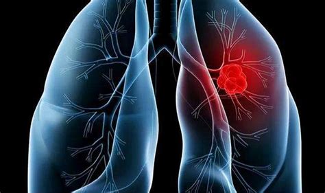 中医认为肺癌是怎么形成的_中华康网