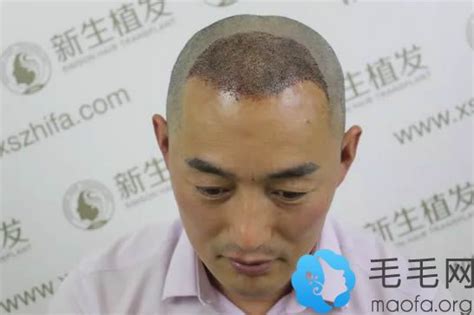 我去年在上海新生植发3000单位毛囊，6个月恢复效果很满意 - 热点资讯 - 毛毛网