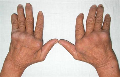 手指肿胀时，或与这些疾病有关，及时检查_资讯频道_东方养生