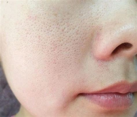 “毛孔粗大”怎么办？掌握这些技巧，有效改善皮肤毛孔粗大的问题