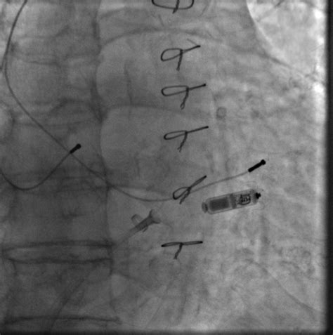 二附院心血管内科再次完成一例无导线心脏起搏器(Micra)植入手术-西安交通大学新闻网