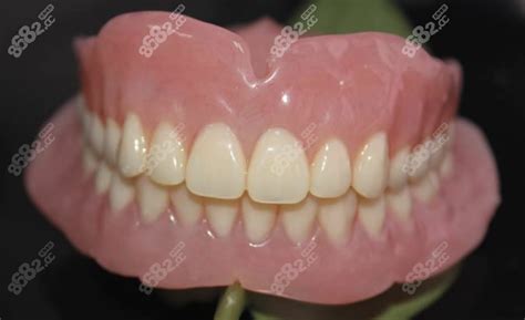 做满口活动假牙的大概价格是多少?含纯钛/维他灵/等价格 - 口腔资讯 - 牙齿矫正网