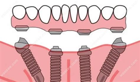 种植牙为什么要做上颌窦内外提升手术?是牙槽骨高度不足哦 - 口腔资讯 - 牙齿矫正网