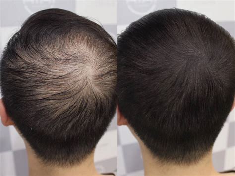 脱发的治疗方法有哪些？经常脱发怎么办？ – 生发垂直网