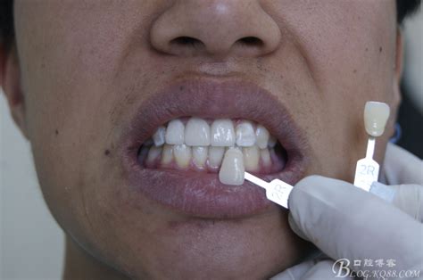 分享一例活动义齿修复病例-单陈鹏的博客-KQ88口腔博客