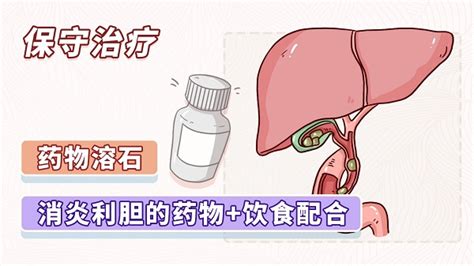 中华医学会 科普图文 得了胆结石就要切掉胆囊吗？想要保胆怎么治？