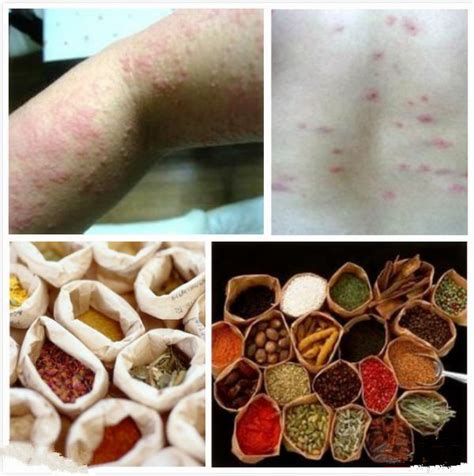 荨麻疹怎么引起的原因（荨麻疹发作有哪些危害？荨麻疹总是反复，或与5个诱发因素有关） | 说明书网