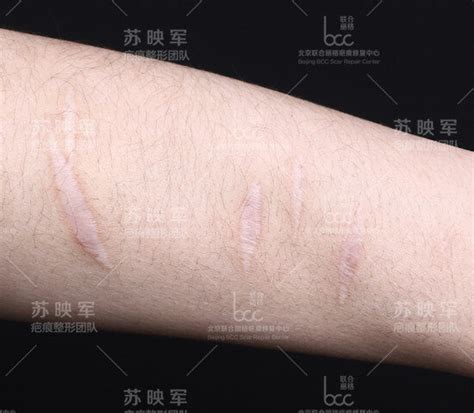 郑州市第二中医院：缝针疤痕怎么才能去除?_伤口_组织_皮肤