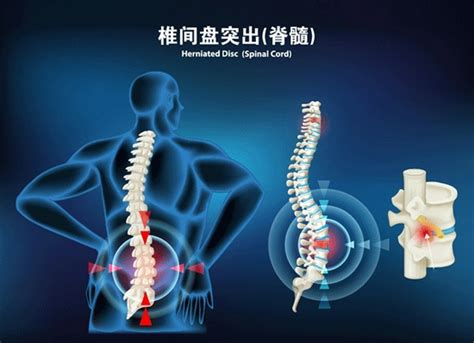 腰椎间盘突出最好的治疗方法 三种方法供你参考_手机新浪网