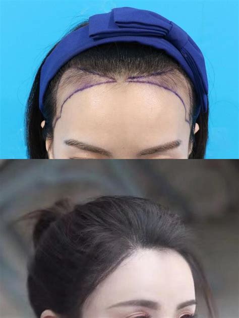 中华医学会 科普图文 植发可以用体毛或者别人的头发吗？这些常识你需要了解一下！