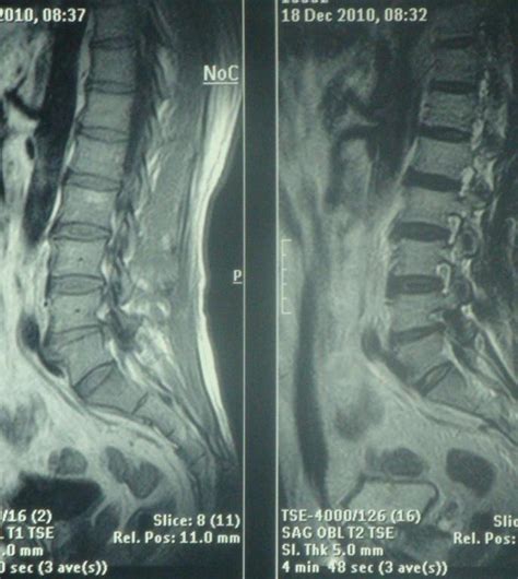 腰间盘突出图片
