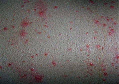 小孩身上荨麻疹图片症状及护理（痒得不行！孩子得了荨麻疹，该怎么办？） | 说明书网