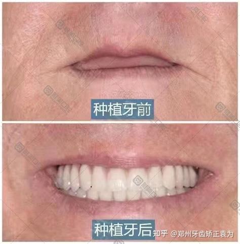 老年人做种植牙有年龄上的限制吗_漳州卫生职业学院附属口腔医院