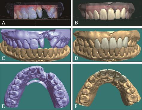 【真数字·真品质】实力剖析真正的数字化种牙论导板设计的重要性_广州德伦口腔