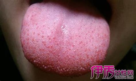 芒刺舌图片