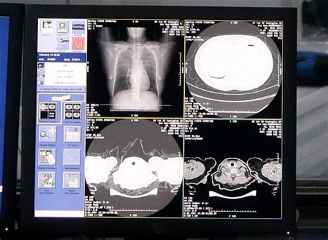 阿里全新AI诊断技术：新冠肺炎CT影像识别准确率达96% 平均不到20秒-摩尔芯闻