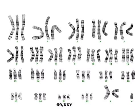 染色体及染色体常见疾病-太和医院