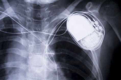 世界最小的心脏起搏器，你知道吗？——上海市胸科医院起搏团队带您了解 -- 严道脑血管网