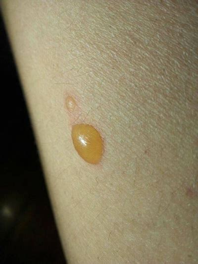 黄水疮的症状图片