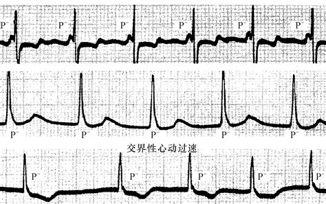 交界性并行心律的心电图RR序列及心电散点图特征 - 心血管 - 天山医学院
