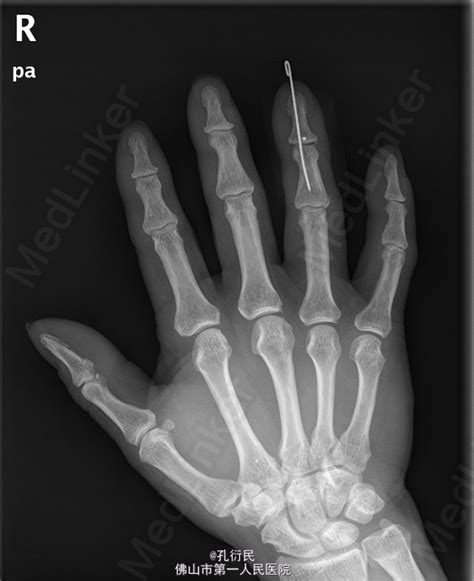 手指肿胀时，或与这5种疾病有关，及时检查，对应治疗