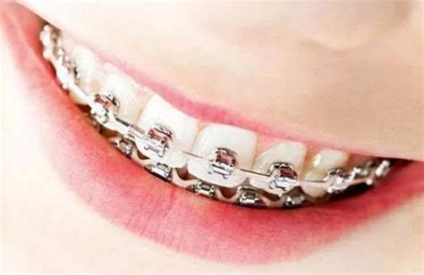 2022高考戴牙套需要证明吗(辽宁2022高考顺序时间) – 爱豆网