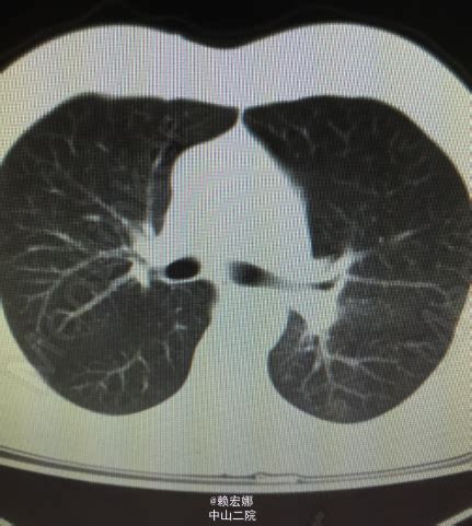 肺鳞癌早期症状有哪些？ - 知乎